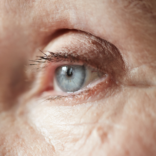 Canthoplasty